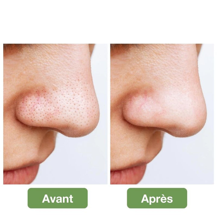 Aspirateur de points noirs du visage