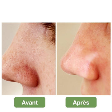 Aspirateur de points noirs du visage