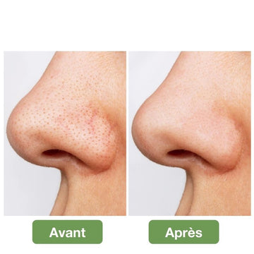 Aspirateur de points noirs du visage